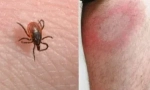 Jak przenoszona jest borrelioza (choroba lyme)?